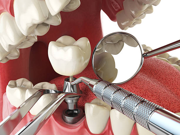 Best Dental Abscess Treatment in Saginaw, TX